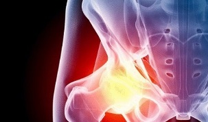 причины развития остеоартроза бедра